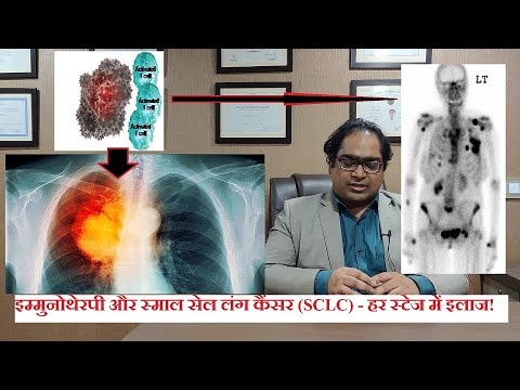 स्माल सेल फेफड़े कैंसर का इलाज - DM(AIIMS) - स्टेज 3 स्टेज 4 फेफड़े कैंसर की दवा हिंदी में 2021