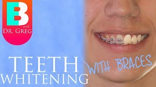 Teeth Whitening With Braces & Invisalign