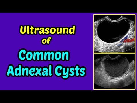 Ultrasound of Common Adnexal Cysts