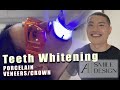 Teeth whitening  luxury suites w dhamare  a1 smile design  p8
