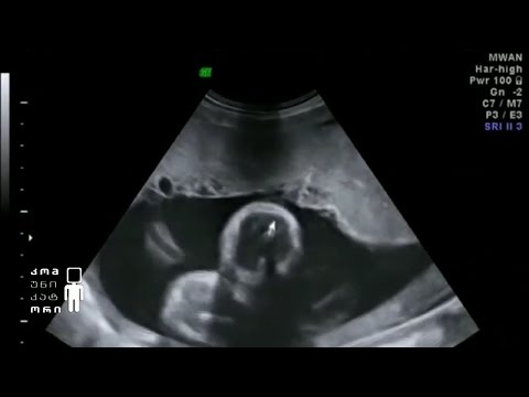 ვიდეო: ორსულობის მეათე კვირა