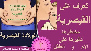 العمليات القيصرية آثارها وتأثيراتها على صحة الام والطفل cesarean section1