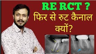 What is Re Rct ? Re root canal treatment kya hota hai |