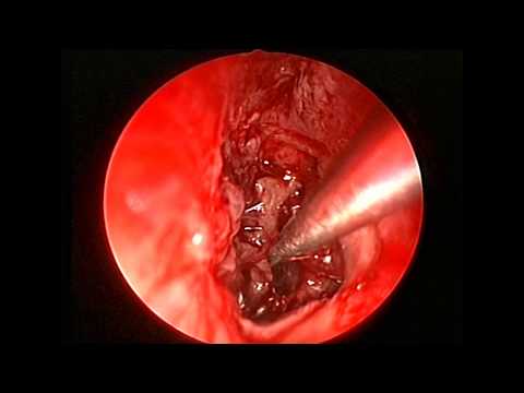 Videó: Tubo-otitis - Tünetek, Okok, Kezelés, Lehetséges Szövődmények