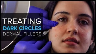 Treating Dark Under-Eye Circles With Dermal Fillers at Mabrie Facial Institute