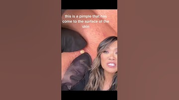 POP peave these are not whiteheads!