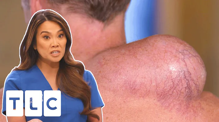 Dr Lee Surprised By Mans MASSIVE Growth On His Sho...