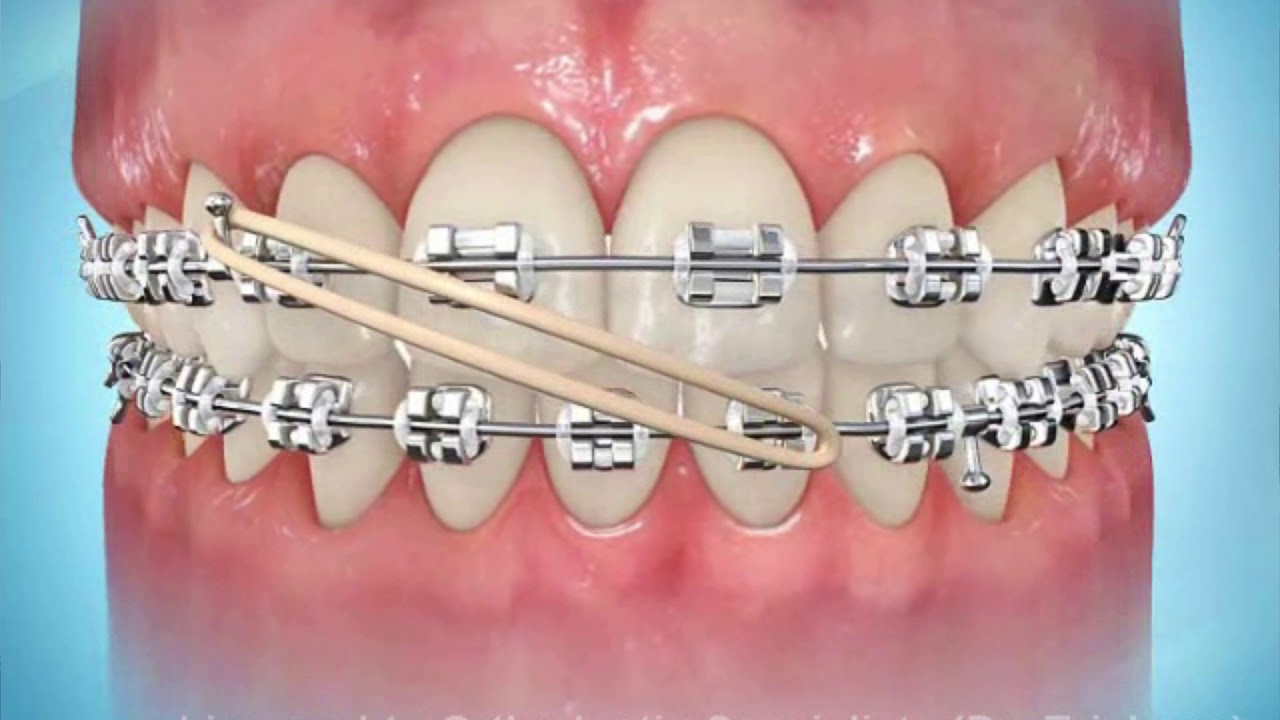 Types of Orthodontic Elastics And Why You Need to Wear Them