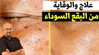 أسباب ظهور البقع السوداء وكيفية علاجه والوقاية منه الدكتور عماد ميزاب Docteur Imad Mizab