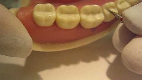 Class II Composite Restoration Part 3/3