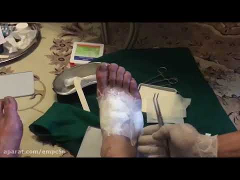 تصویری: 3 روش آسان برای درمان سوختگی پا