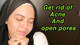 GET RID OF ACNE AND OPEN PORES | TIPS FOR ACNE PRONE SKIN | OILY SKIN  |SABA IBRAHIM