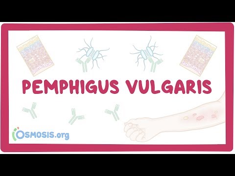 pemphigus-vulgaris