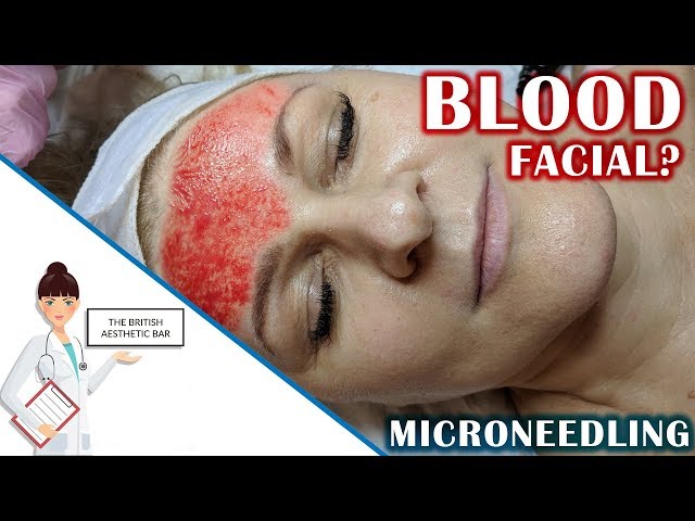 Microneedling Procedure | The British Aesthetic Bar