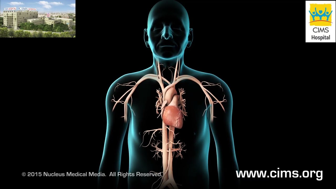 TAVI   Transfemoral Approach