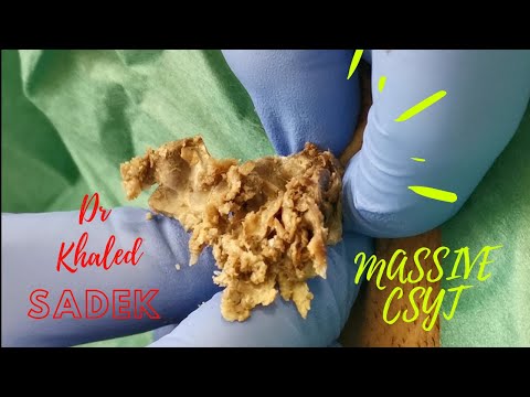 Massive Armpit Cyst. Dr Khaled Sadek. LipomaCyst.com