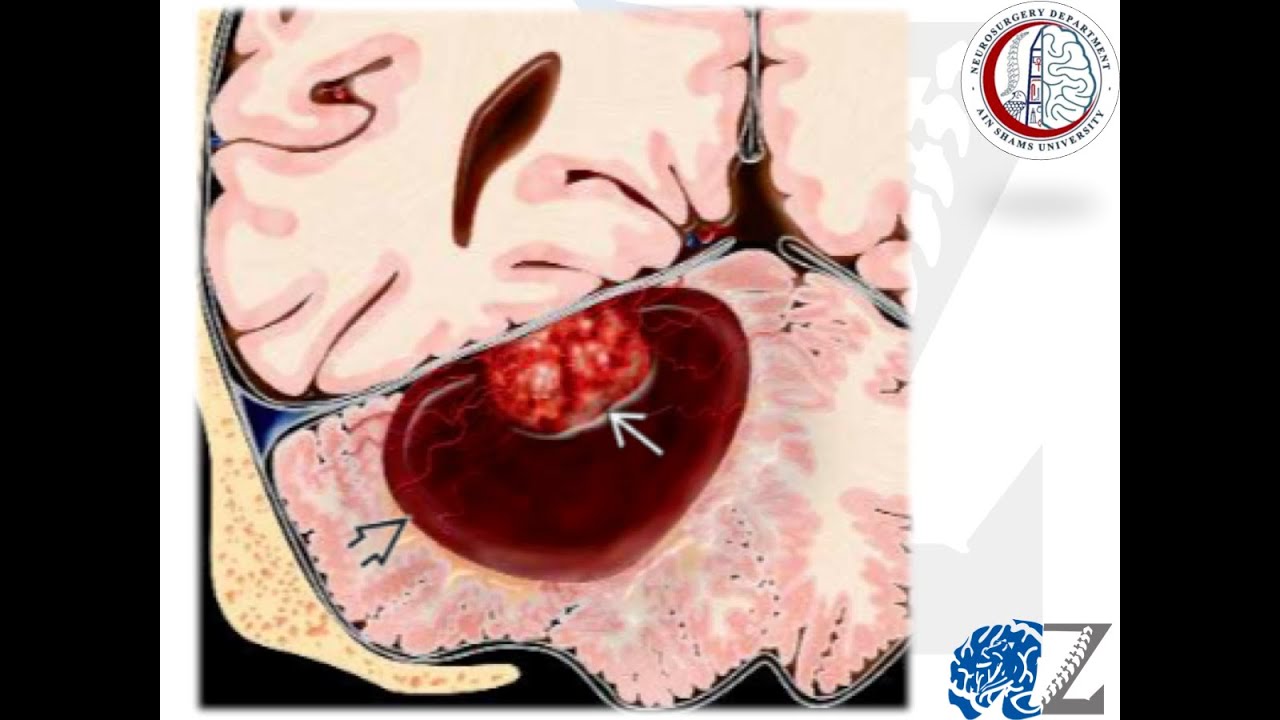 Brain Tumours (37)  Hemangioblastoma (1)  الورم الأرومي الوعائي