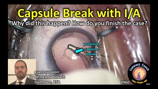 posterior capsule break during I/A in cataract surgery