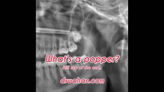 Wisdom Tooth Pops Out