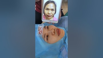 Cắt mí mắt Không đau – Không sưng – Đẹp ngay sau 30 phút thực hiện | BS Tuấn Dương