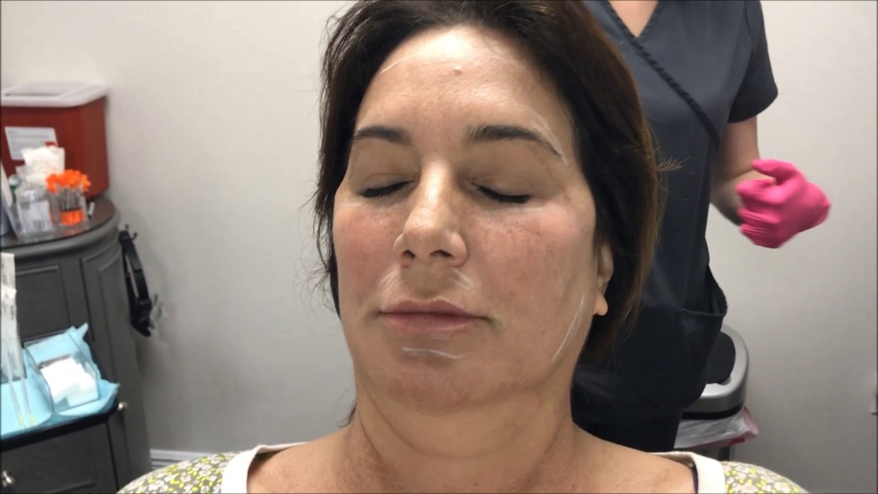 PDO Threads Tear Trough