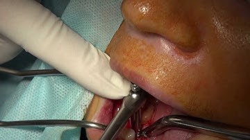 Ankylos plus - YouTube_6