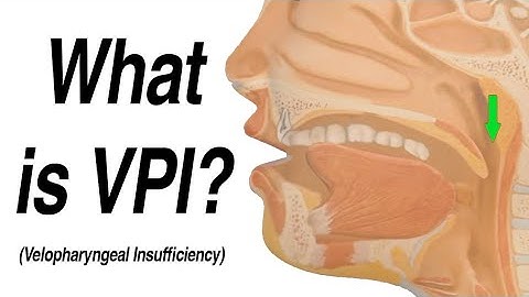 Velopharyngeal Insufficiency (VPI) Causing Hypernasal Speech and Nasal Regurgitation with Swallow