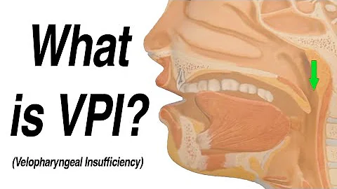 Velopharyngeal Insufficiency (VPI) Causing Hypernasal Speech and Nasal Regurgitation with Swallow