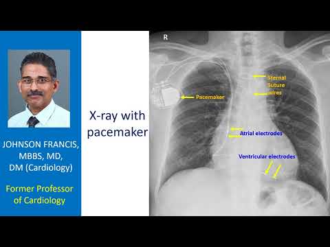 X-ray with pacemaker