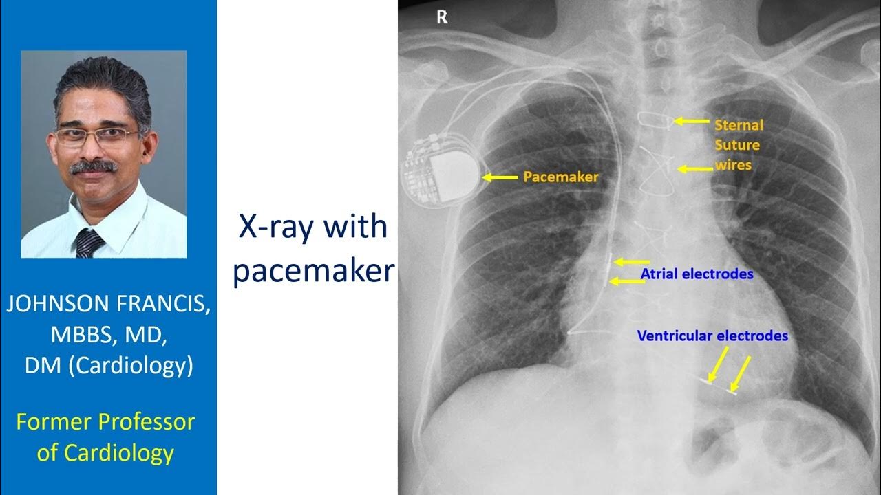 X ray With Pacemaker YouTube x-ray-with-pacemaker-youtube
