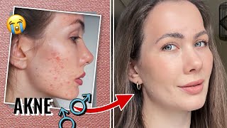 Hormonelle Akne Bekämpfen - So Habe Ich Mich Heilen Können