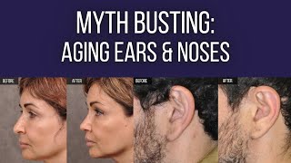 Myth Busting Aging Noses Ears Dr Ben Talei Beverly Hills Plastic Surgeon