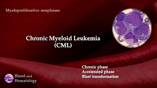 Chronic Myeloid Leukemia (CML)