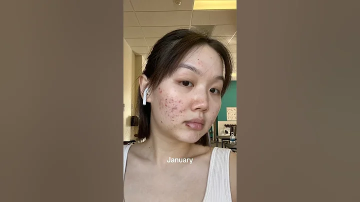Ain’t it sad 🥲 #acne #hormonalacne #acnejourney #viral #shorts