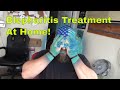 Blepharitis Treatment At Home! Use a Heated Eye Mask Like This!