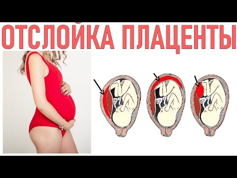 ОТСЛОЙКА ПЛАЦЕНТЫ ПРИ БЕРЕМЕННОСТИ | К чему приводит отслойка плаценты на ранних сроках беременности