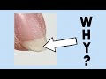 Nail Peeling! Why it happens and how to work with it!