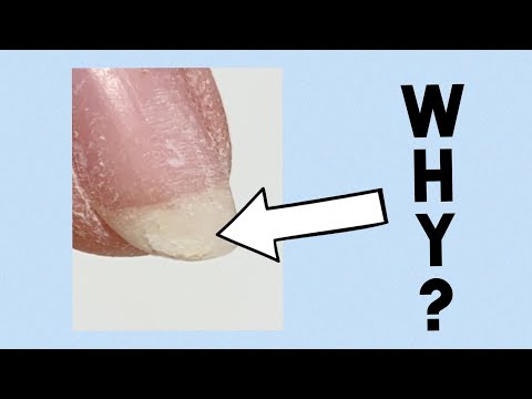 Nail Peeling! Why it happens and how to work with it!