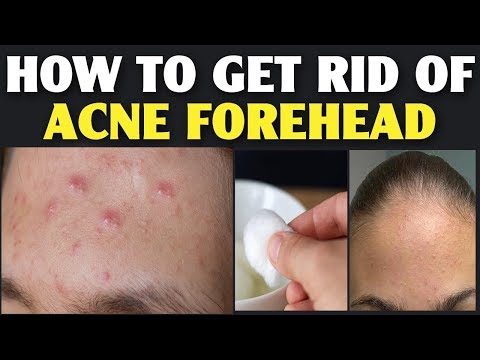 How to Get Rid of Acne Forehead | How to Get Rid of Acne on Forehead With Home Remedies