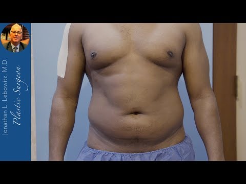 Video: How To Remove A Male Belly