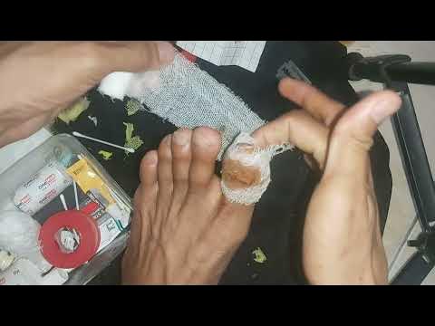Cara mengganti perban di kuku cantengan jempol kaki kita yang suda di