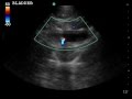 Right Hydroureteronephrosis, Right UPJ Stone with Twinkling Artifact