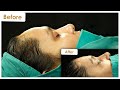 Forehead Reduction l Hairline Lowering Surgery l Post-op 1-4 Day