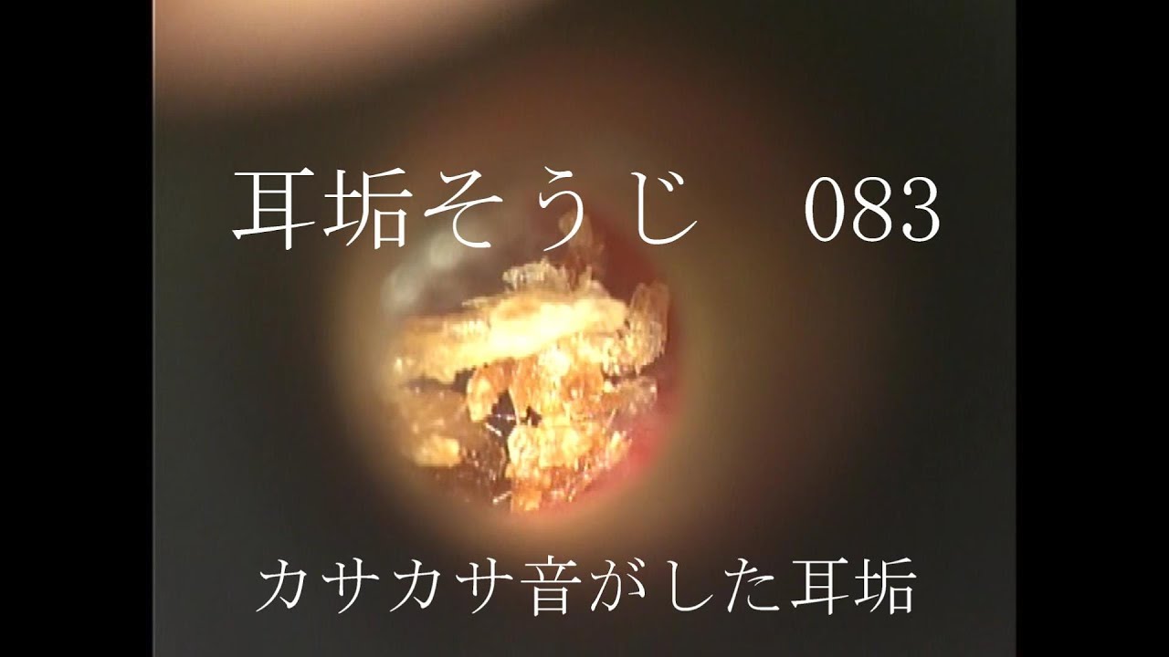 耳垢そうじ カサカサ音がした耳垢 083 Youtube