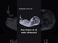 Guess The Gender With Nub Theory Baby Boy Or Girl Pregnancyjourney Ultrasound Pregnancytips Guess The Gender With Nub Theory Baby Boy Or Girl Pregnancyjourney Ultrasound Pregnancytips