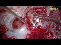 Right Mastoidectomy with Ossicular Reconstruction using Glass Ionomer-done by Dr.Meenesh Juvekar.