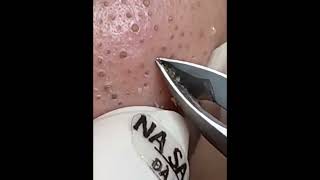 ASMR Satisfying extreme Blackhead Removal Animation Blackhead Extrusion on nose Skincare at home