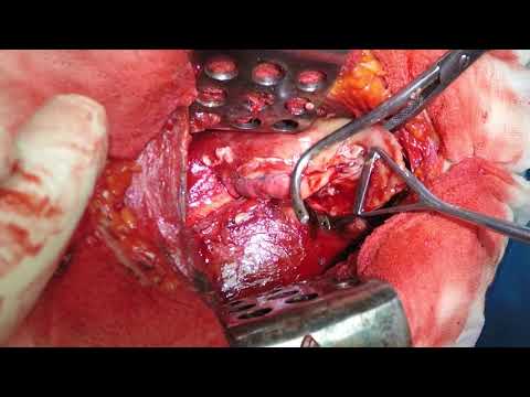 Декортикация свищ