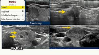 How to calculate TIRADS score for thyroid lesion (Thyroid Ultrasound Part II)