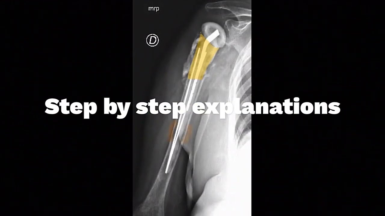 Revision of infected reverse shoulder arthroplasty